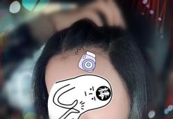 -大麦微针植发全国连锁