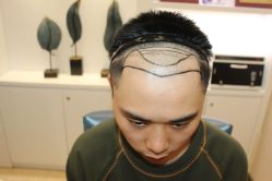 -大麦微针植发丨全国连锁