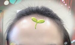 -大麦微针植发全国连锁