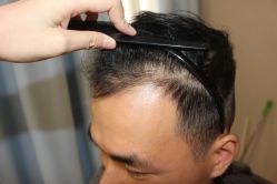 -大麦微针植发丨全国连锁