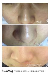 点击看大图 opt光疗可以收缩毛孔 消炎祛痘-光SPA科技美肤