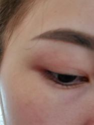 体验后-丽美妍医疗美容·皮秒·立体分层抗衰