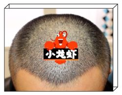 -大麦微针植发全国连锁