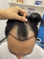 -大麦微针植发全国连锁