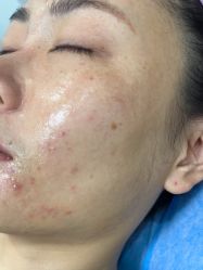 体验后-美安心医美·美迪迈黄金微针·美拉美医疗美容
