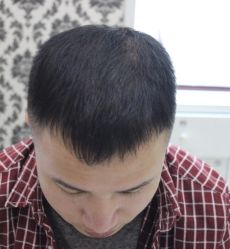 -大麦微针植发全国连锁