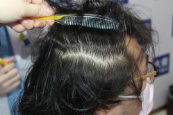 -大麦微针植发丨全国连锁