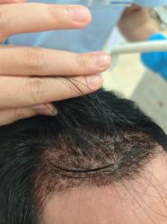-大麦微针植发全国连锁