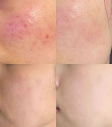 -美肤盾祛痘·问题肌头疗管理中心