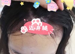 -大麦微针植发全国连锁