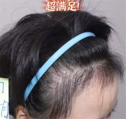 -大麦微针植发全国连锁
