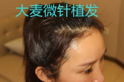-大麦微针植发丨全国连锁