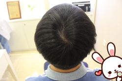 点击看大图 -大麦微针植发丨全国连锁