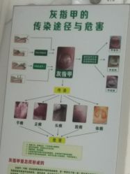 -德哥灰指甲脚气甲沟炎跖疣护理