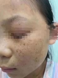 -苗方清颜专业祛痘连锁机构