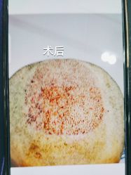 体验后-北京雍禾植发医院