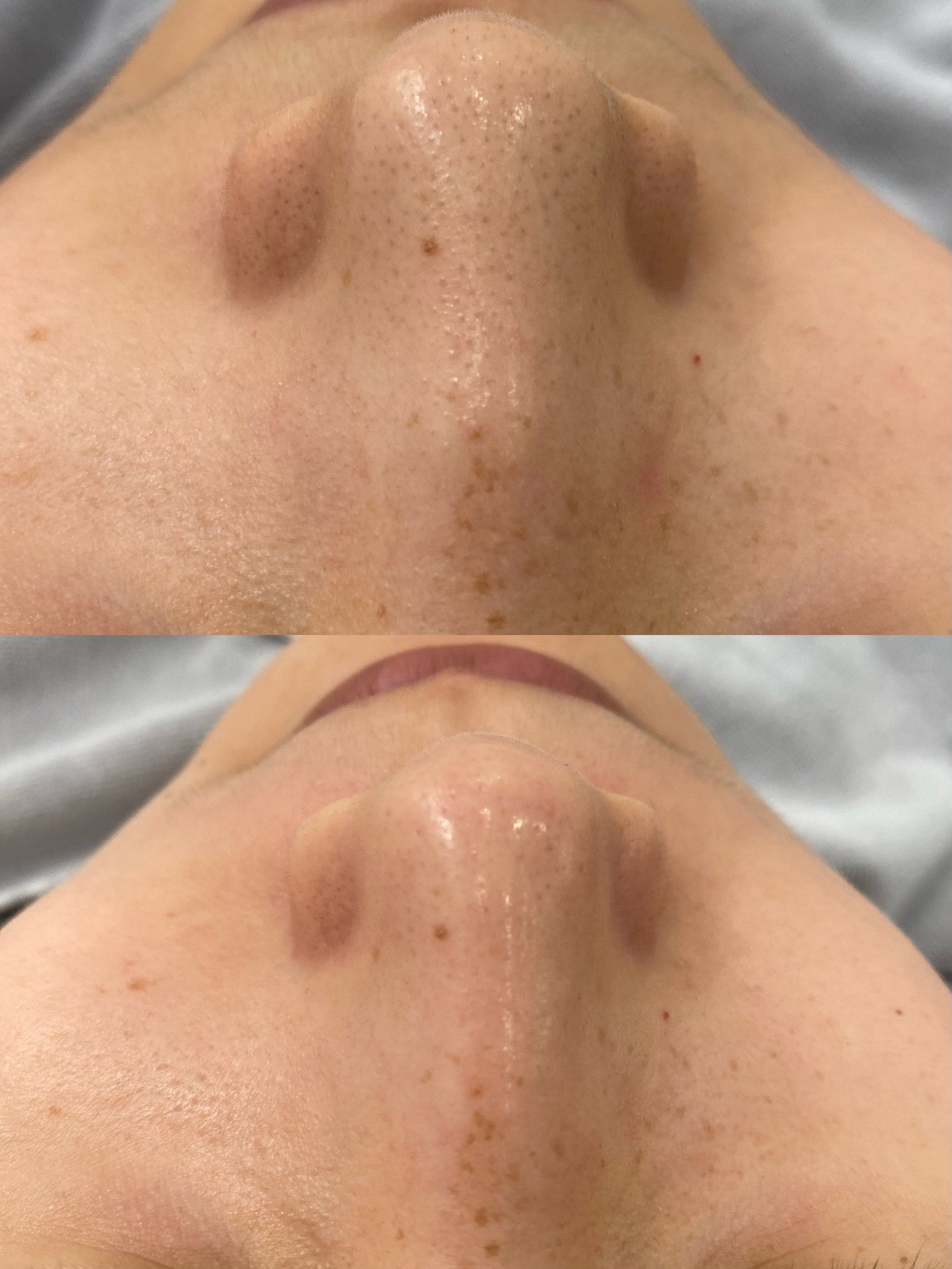 祛黑头一次效果对比