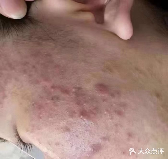 瑶芳清颜草本祛痘(花园街店)图片