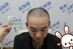 -大麦微针植发丨全国连锁