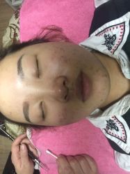 -苗方清颜专业祛痘