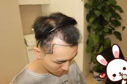 点击看大图 -大麦微针植发丨全国连锁