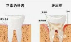 牙齿松动还痛，这是典型的牙周病或重度牙周病的表现