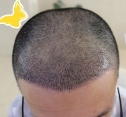 -大麦微针植发丨全国连锁