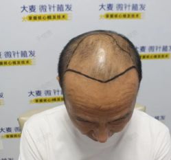 -大麦微针植发丨全国连锁