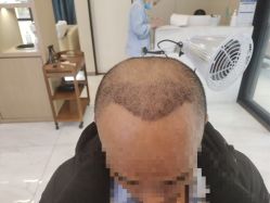 -大麦微针植发丨全国连锁