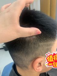 体验后-大麦微针植发全国连锁