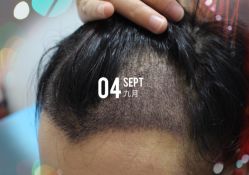 -大麦微针植发全国连锁