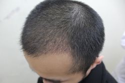 点击看大图 -大麦微针植发丨全国连锁