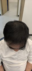 -大麦微针植发全国连锁