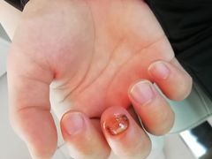 -新甲连锁灰指甲·甲沟炎·鸡眼(黑龙江路店)