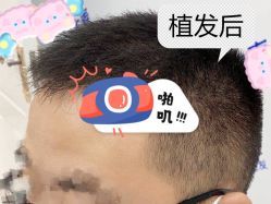 -大麦微针植发全国连锁