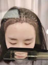 体验前-大麦微针植发全国连锁