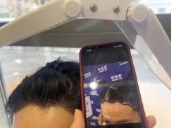 -碧莲盛·不剃发植发