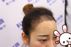 -大麦微针植发丨全国连锁