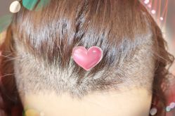 -大麦微针植发全国连锁