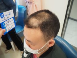 -大麦微针植发丨全国连锁