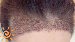 -大麦微针植发丨全国连锁