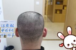 -大麦微针植发丨全国连锁