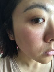 体验后-亿美医疗美容·半岛大超炮官方授权店