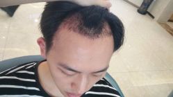 -大麦微针植发丨全国连锁