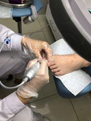 点击看大图 -派恩宜灰指甲鸡眼嵌甲手足癣