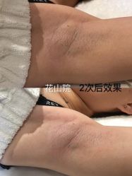 -觅屿日式脱毛美肤