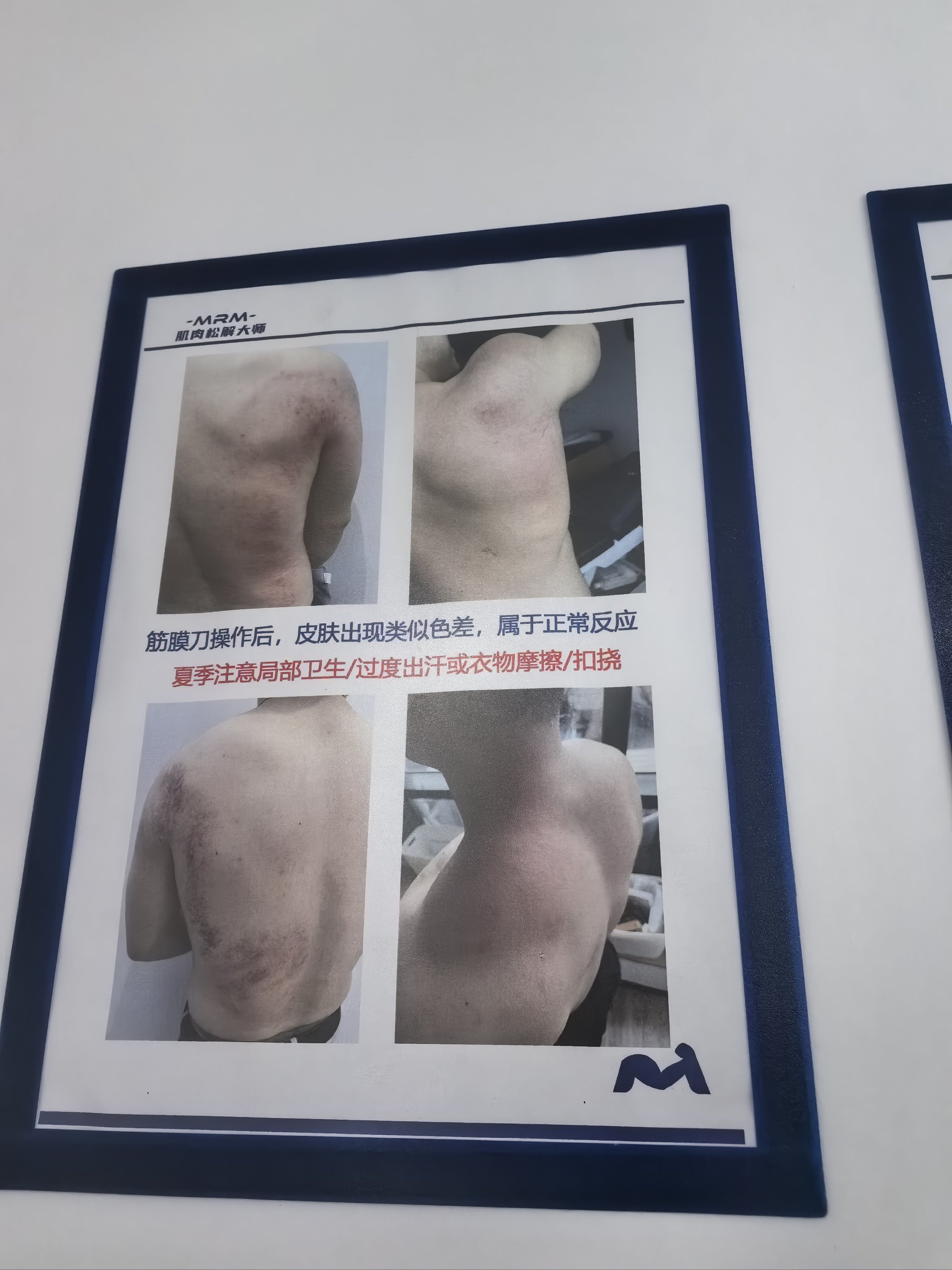  疫情康复后遗症是什么样的(疫情康复后遗症是什么样的呢)