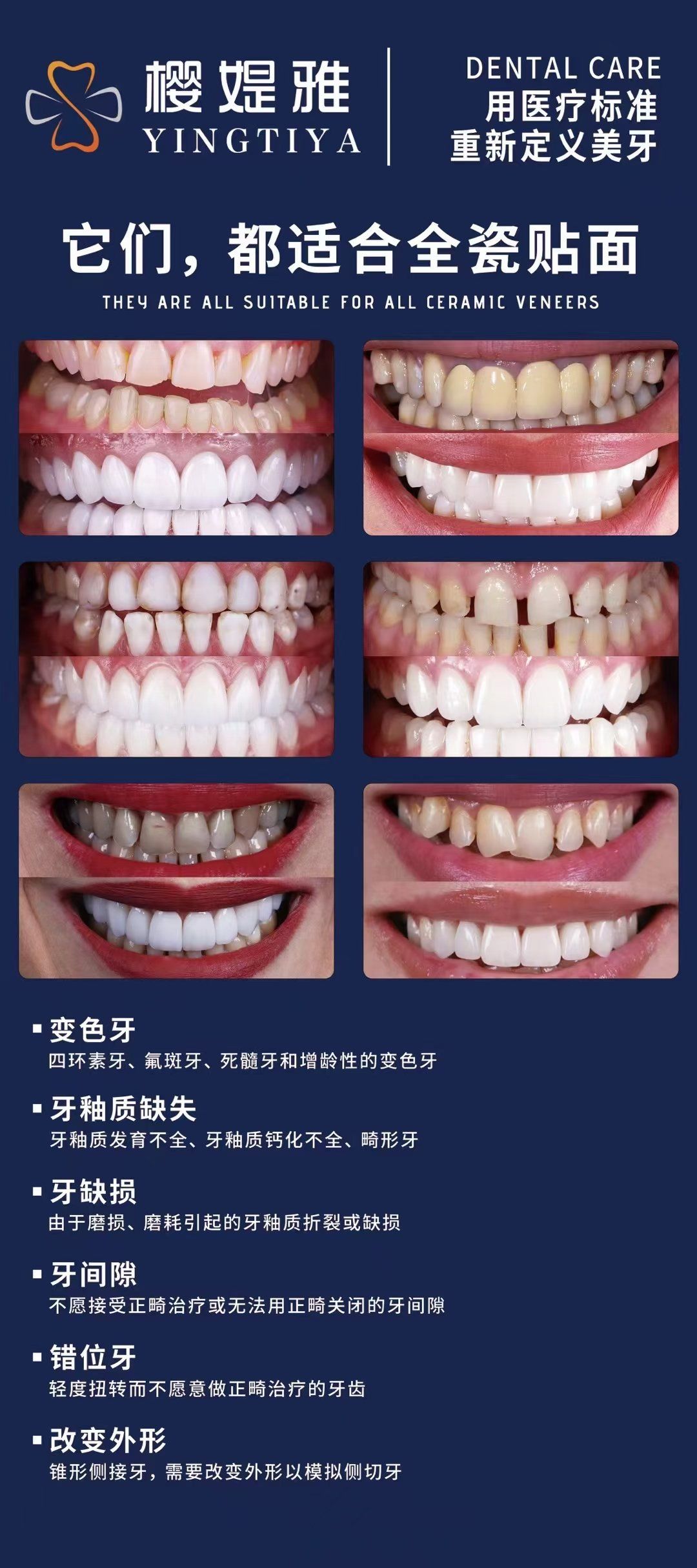 全瓷贴面