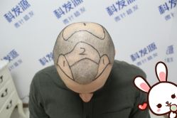 -大麦微针植发丨全国连锁