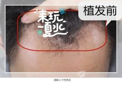 -大麦微针植发全国连锁